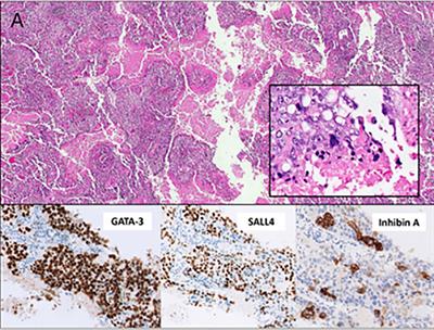 Case report: Using DNA short tandem repeats to confirm nongestational origin of pulmonary choriocarcinoma